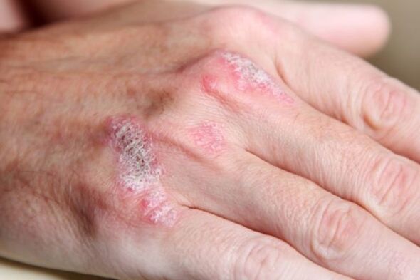 симптоми на псориазис по ръцете