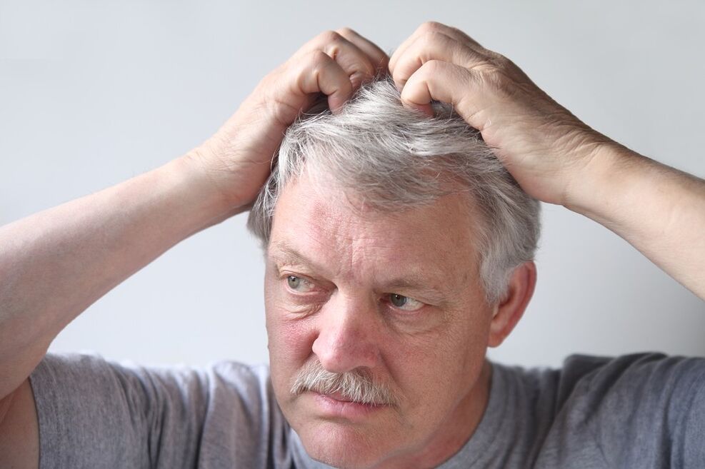 Симптоми на псориазис на главата