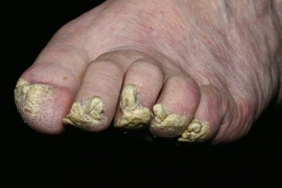 псориазис на ноктите на краката