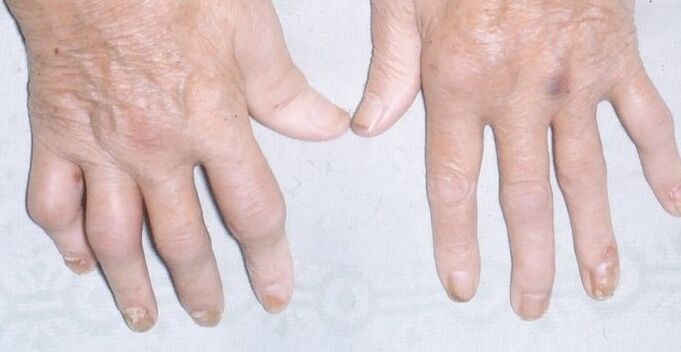 Артропатичен псориазис на ръцете