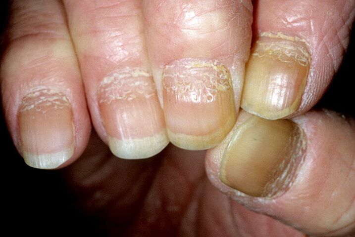псориазис по ноктите