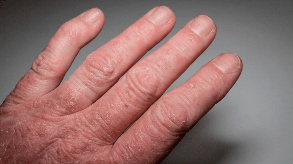 псориатичен артрит на ръцете
