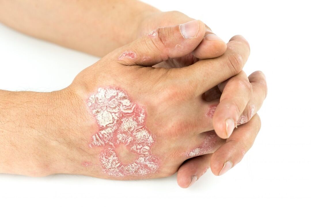 как изглежда псориазисът на ръцете