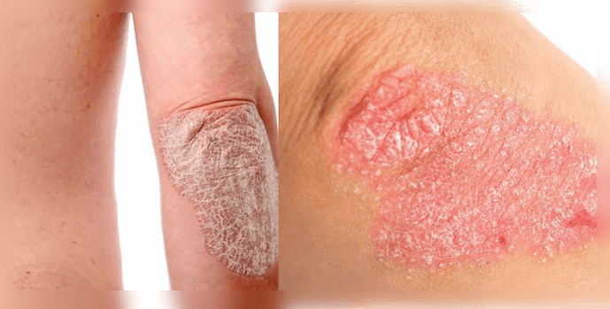 как изглежда псориазисът на кожата