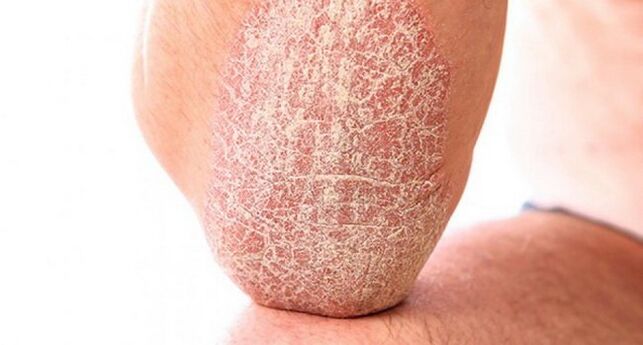 псориазис вулгарис по кожата