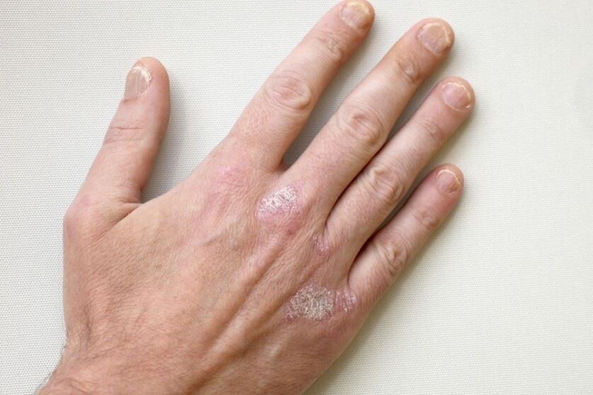 Задължителен симптом на псориазис са плаките с люспи по кожата