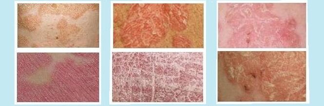 Кожни обриви, характерни за различни видове псориазис