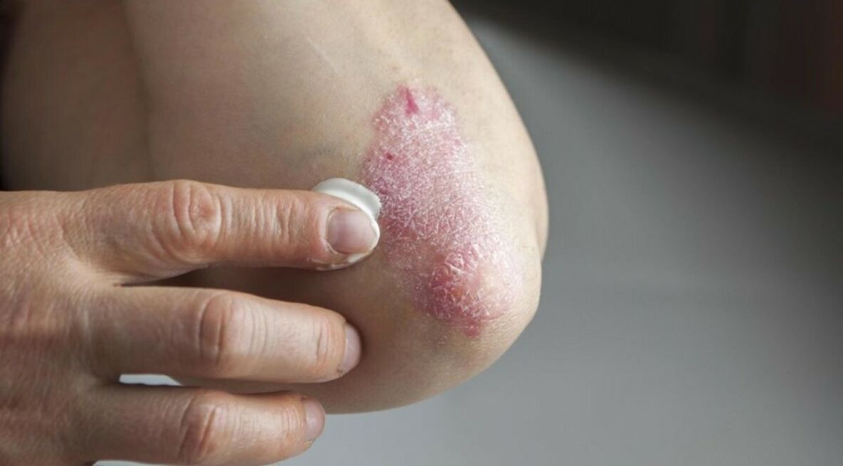 Псориазис, засягащ кожата, лечението на което включва използването на мехлеми