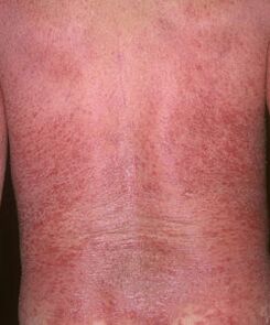 Еритродермия