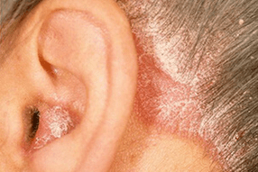 причини за псориазис