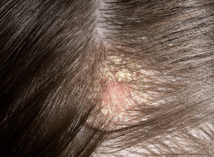 основните симптоми на псориазис на главата