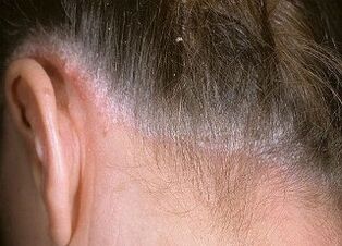 причини за псориазис на главата