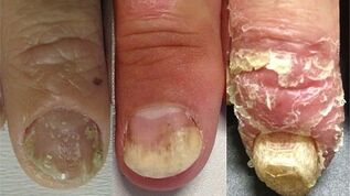 етапи на развитие на псориазис на ноктите