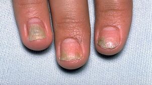причини за псориазис по ноктите